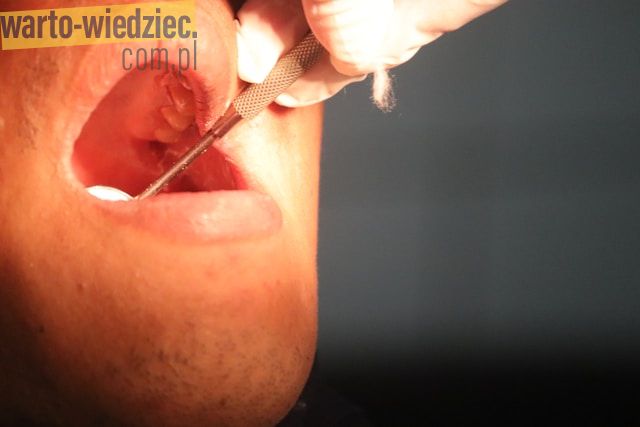 Rola pielęgnacji błon śluzowych w ogólnej higienie jamy ustnej: klucz do zdrowia